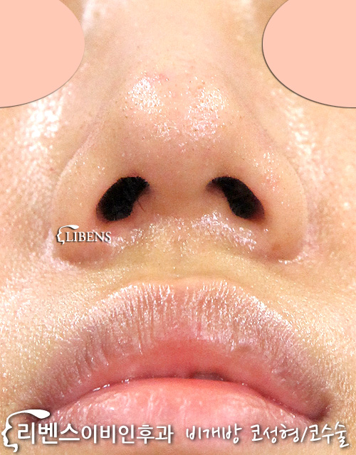 눌린 콧구멍 코끝 수술 높이기 무보형물 매부리 메부리 코뼈 갈기 성형 s659